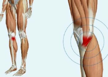 Tendinitis de la Pata de Ganso